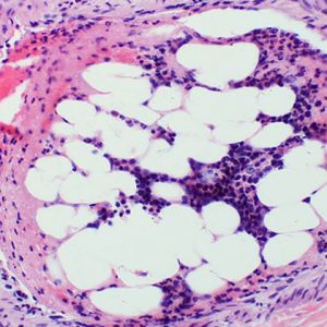 Bone Marrow Cells